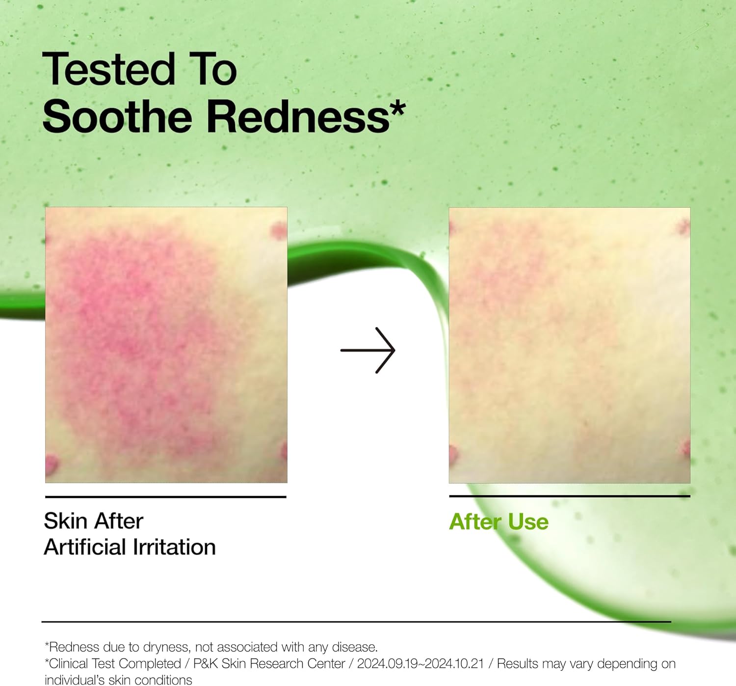 Anua Azelaic Acid 10 Hyaluron Redness Soothing Serum 30ml